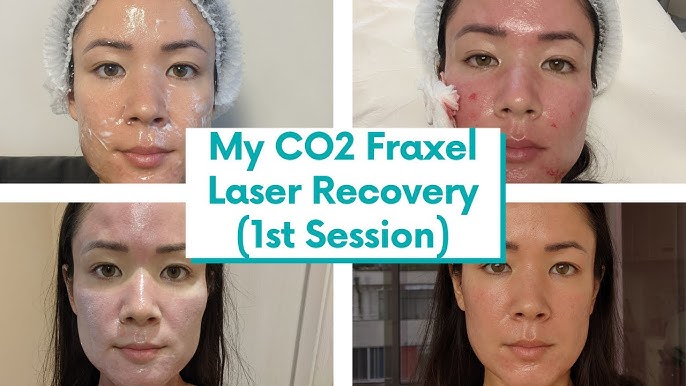 2017 Rohrer Aesthetic Phoenix-15 CO2 Laser Fine Lines Wrinkles Skin  Rejuvenation