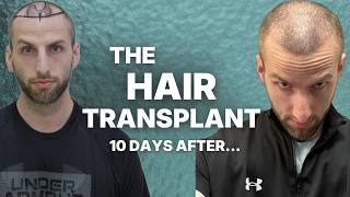 Hair Transplant Results - Do I Regret it?