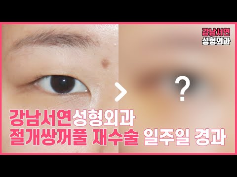 짝눈교정 절개쌍꺼풀 재수술 일주일 리얼 후기  l 강남서연성형외과