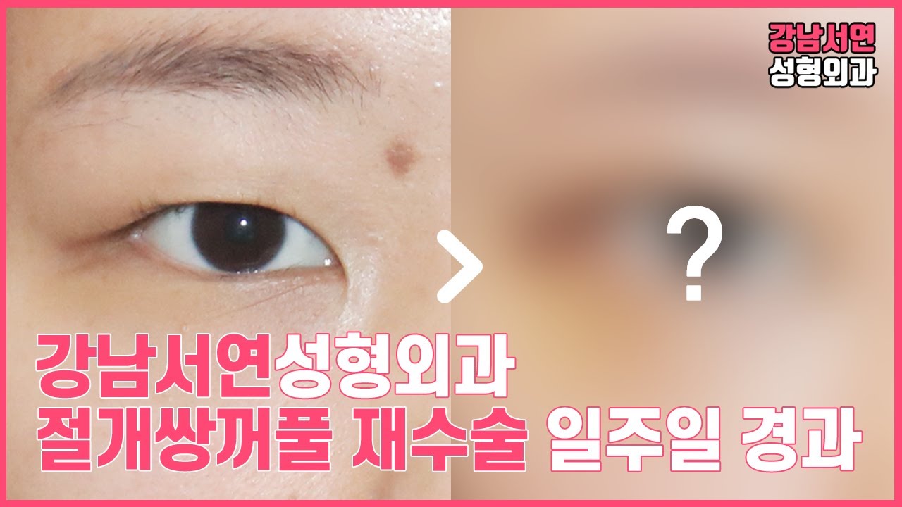 [Bệnh viện phẫu thuật thẩm mỹ Gangnam Seoyeon] Đánh giá thực tế một tuần sau phẫu thuật lại sụp mí mắt rạch để chỉnh mắt lệch l Bệnh viện phẫu thuật thẩm mỹ Gangnam Seoyeon