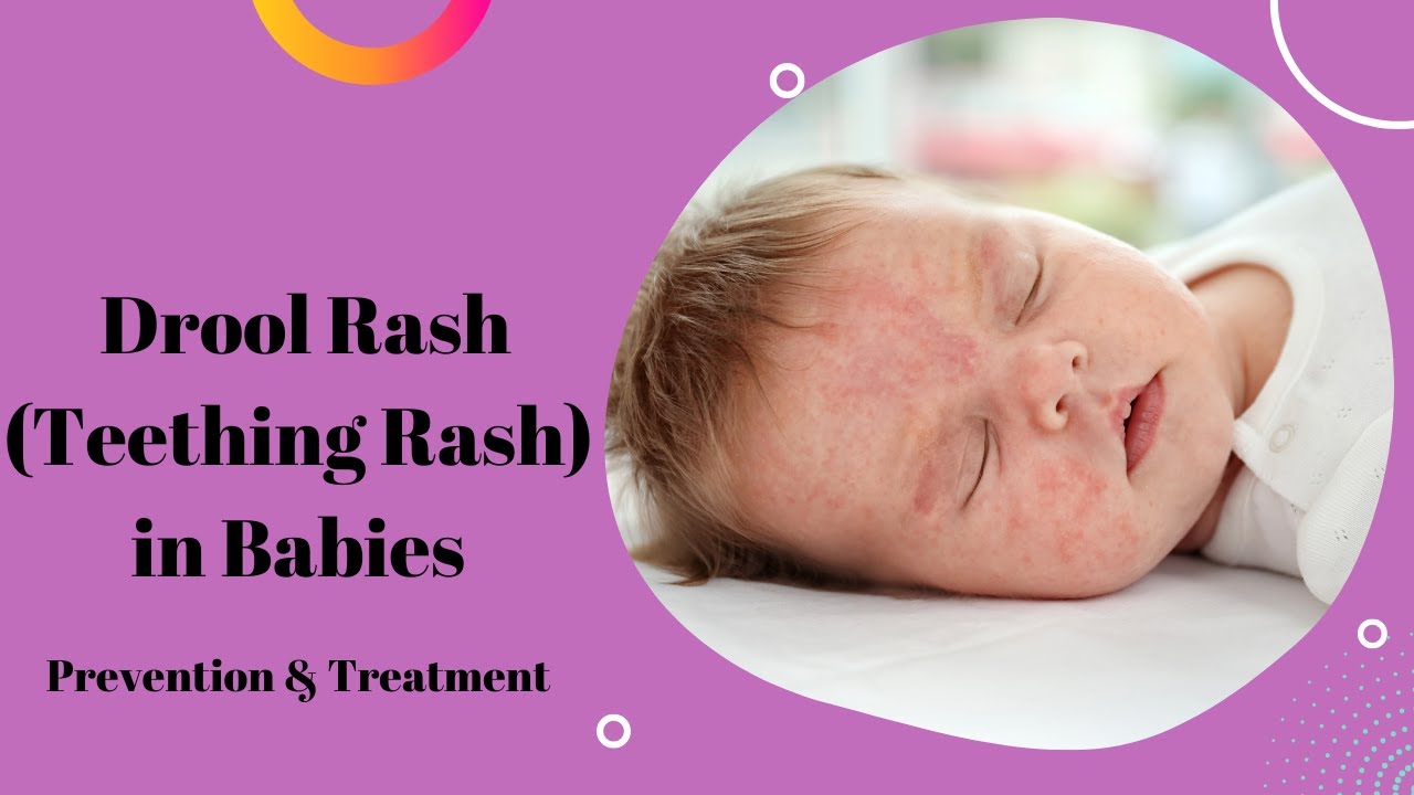 Drool Rash (Teething Rash) in Babies: Prevention & Treatment|Rashes In ...
