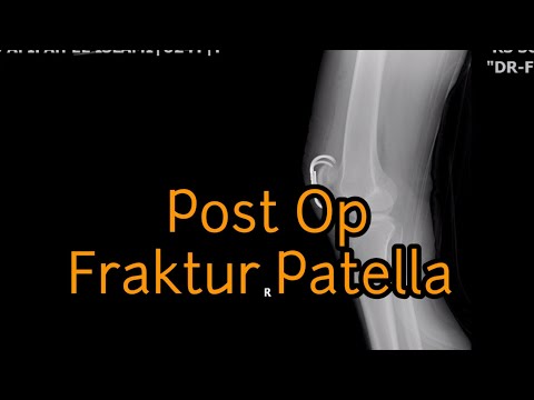 Latihan pasca operasi tempurung lutut ||post op fraktur patella