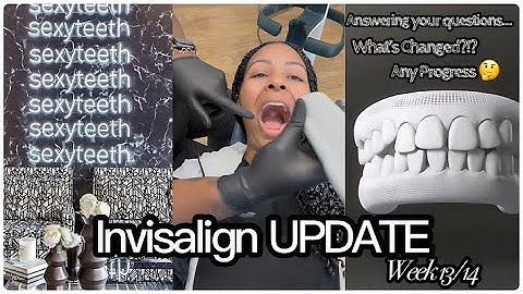 My Invisalign Story|Week 13/14 UPDATE| Answering Your Questions| Tray Demo