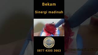 kolesterol tinggi bikin tubuh tidak stabil #bekam #bekamjakarta #kolesterol #stroke #jantung