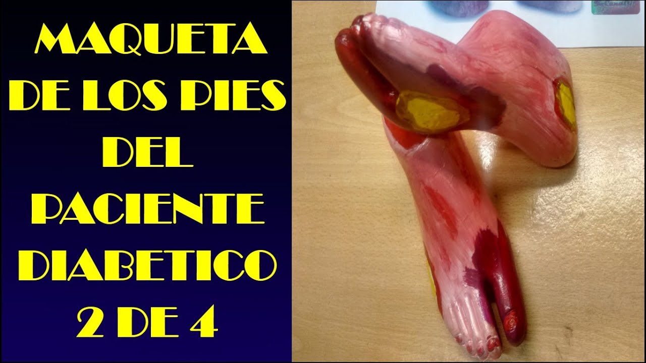 MAQUETA DE LOS PIES DEL PACIENTE DIABETICO 2 DE 4 YouTube