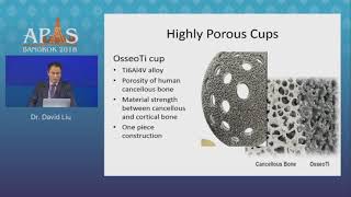 Acetabular Reconstruction Options In Revision Tha - Dr. David Liu