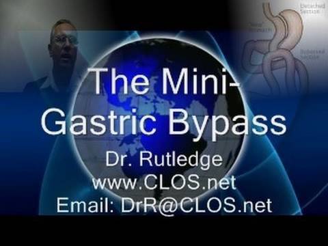 The Story of Dr. Rutledge and the Mini-Gastric Bypass