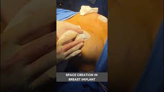 Space Creation for Breast Implants: The Key Step in Breast Augmentation #shorts #shortvideo