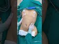 Resultado Lipo 4K