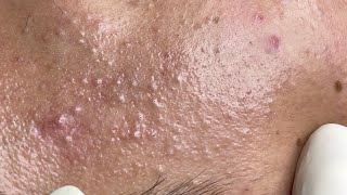 Relaxing Acne Treatment #172(Linh My Dang)P1