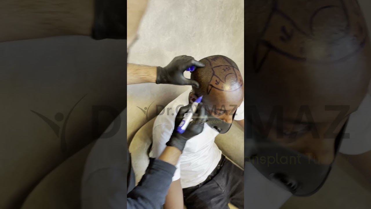 Afroamerican Hair Transplant Hairline