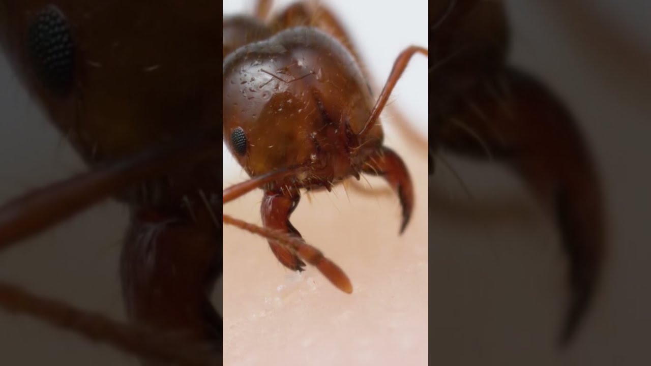 Fire Ant Bite And Sting Up Close 