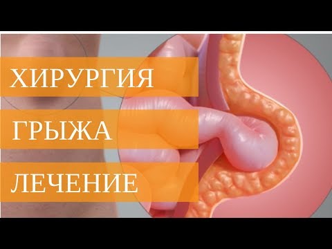 Как избавиться от пупочной грыжи в домашних условиях