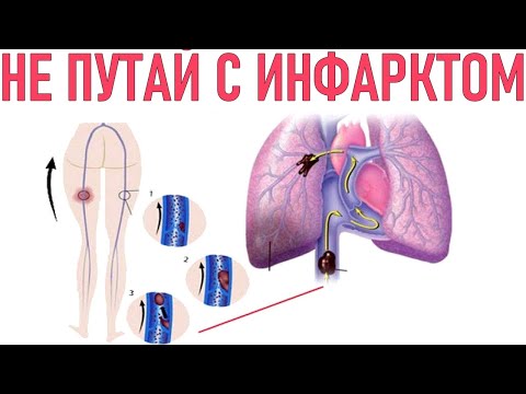 ЛЕГОЧНАЯ ЭМБОЛИЯ | Симптомы легочной эмболии диагностика и лечение | Опасность легочной эмболии