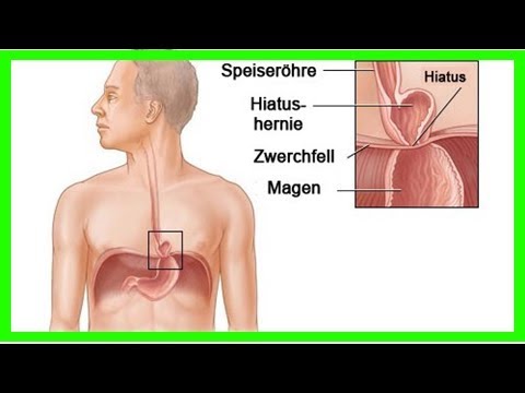 Video: Hiatushernie Natürliche Behandlung + Symptome, Ursachen Und Ernährung