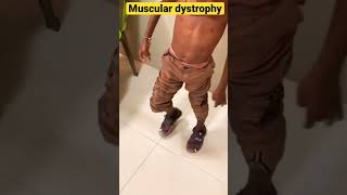Muscular dystrophy