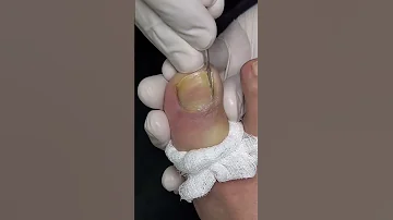 Solución definitiva para uñas incarnadas #nails #foot #podologos