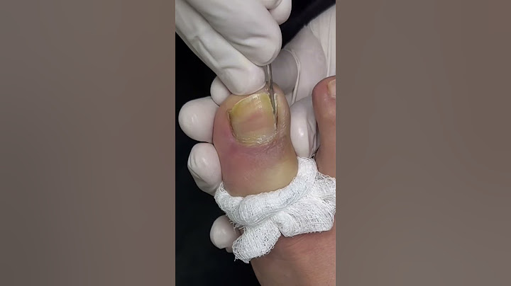 The definitive solution for ingrown toenails #nails #foot #podiatrists