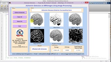 Alzhemier Diseases Detection on MRI Images Using Image Processing Matlab Code IEEE Project