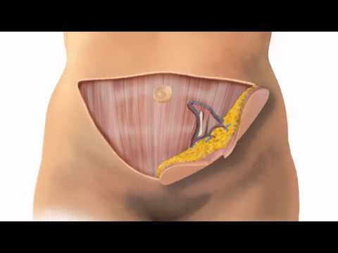 Delayed Breast Reconstruction Surgery