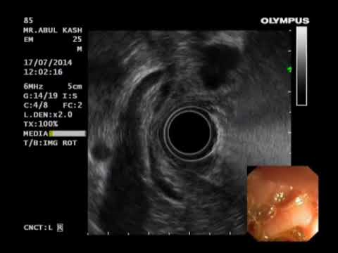 CBD & Portal vein