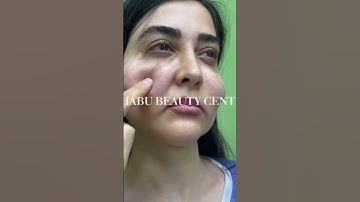 Biến chứng tiêm filler và cách xử lý biến chứng | HABU BEAUTY CENTER #viral #shorts