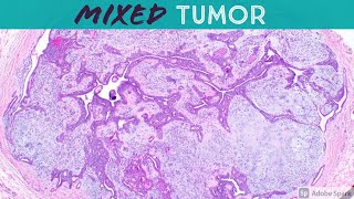 Chondroid Syringoma (Mixed Tumor) - Like Pleomorphic Adenoma of Skin: 5-Minute Pathology Pearls