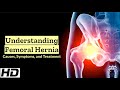 Femoral Hernia Uncovered: A Comprehensive Overview