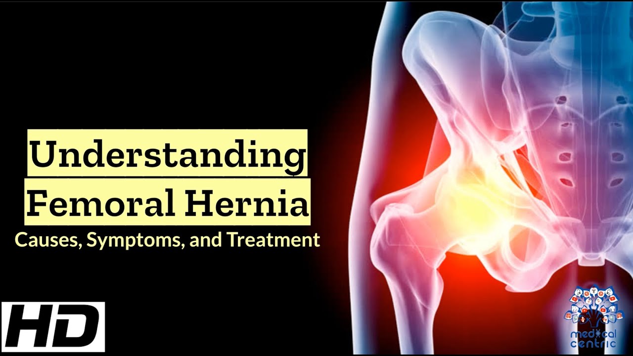 Femoral Hernia Uncovered: A Comprehensive Overview 