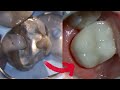 How Silver Fillings are Removed