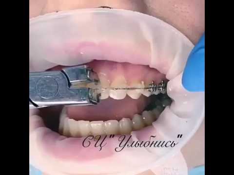 كيفية إزالة الأقواس على يوتيوب