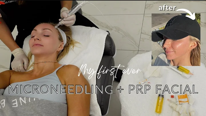 MY FIRST MICRONEEDLING + PRP FACIAL WITH EVERYDAY ...