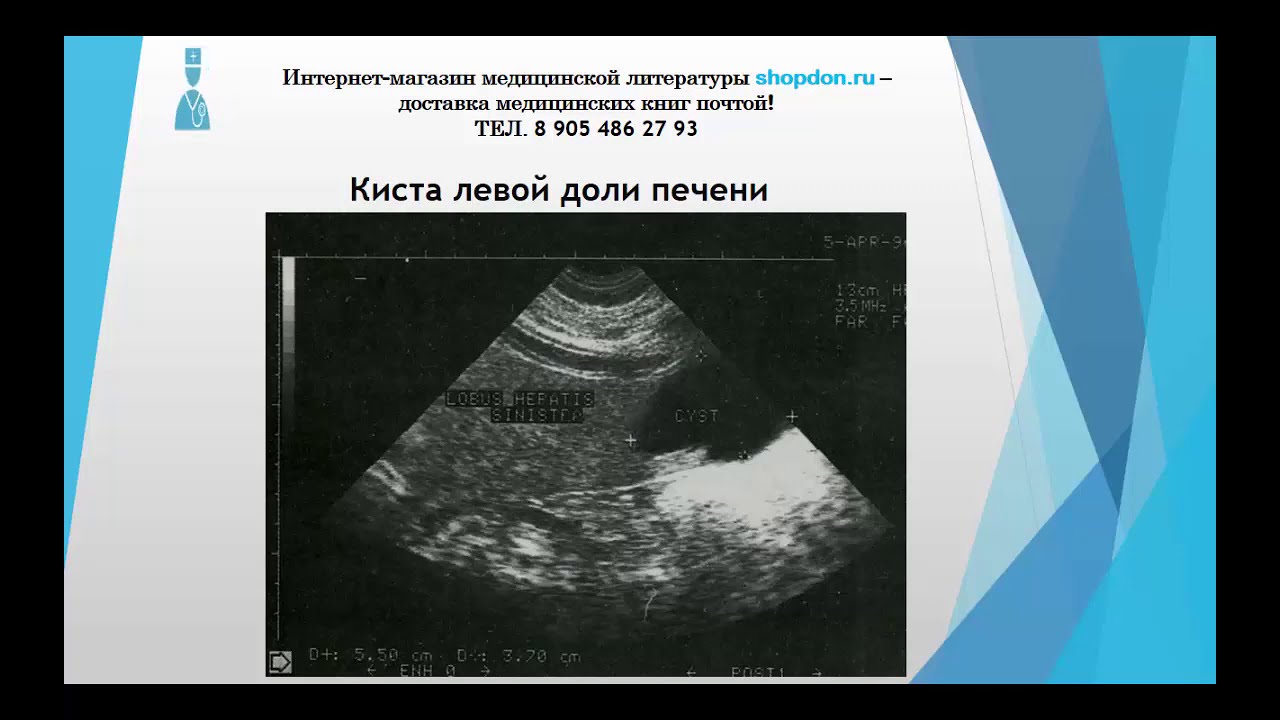 киста левой доли печени на узи. хвостатая доля печени на узи. узи почек лекция изранова по узи. сегменты печени по узи. узи анатомия сегментов печени.