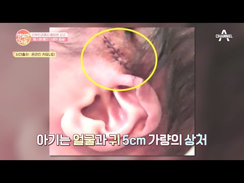 ※분노주의※ 제왕절개 <strong>수술</strong> 후 신생아 얼굴에 메스에 베인 상처가?! | 행복한 <strong>아침</strong> 464 회