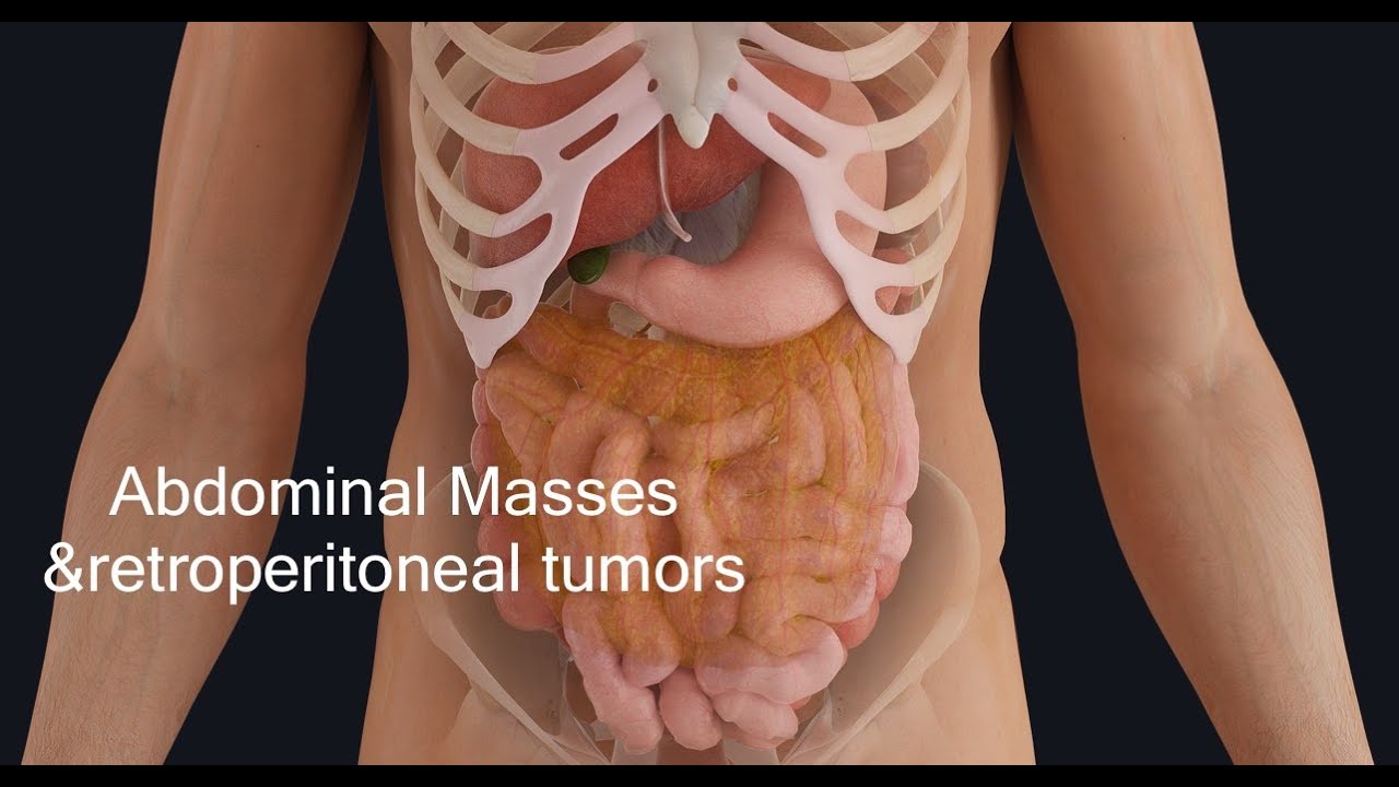 presentation of an abdominal mass