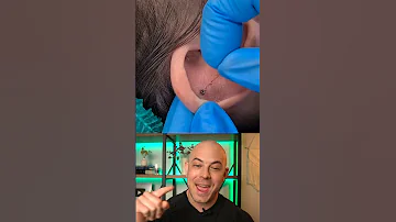 Derm reacts to a very hairy ear-piercing removal! #dermreacts #doctorreacts #earpiercing