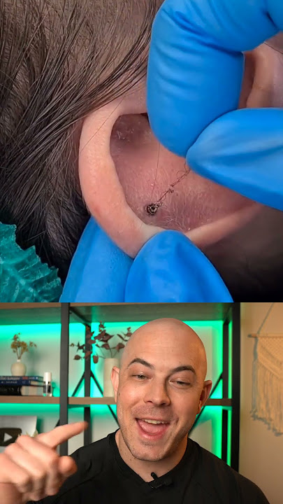 Derm reacts to a very hairy ear-piercing removal! #dermreacts #doctorreacts #earpiercing