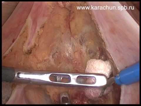 Laparoscopic TME