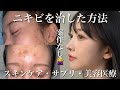 【NO案件!】繰り返すニキビ肌をツルツル美肌にした方法