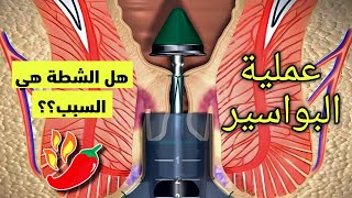 شاهد ما هي البواسير وكيف يتم إزالتها | اسباب البواسير وطرق علاجها Hemorrhoids