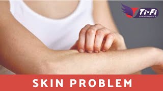 TI FI TESTIMONIALS - Skin Problem