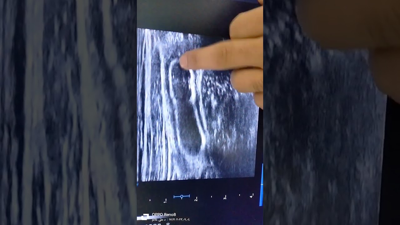 فنيات فحص الزايده الدوديه بالسونار وحالة التهابات بالزايده