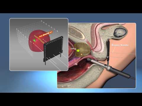 3D Staging Biopsy: The ONLY way to Accurately Detect and Locate Cancer in the Prostate