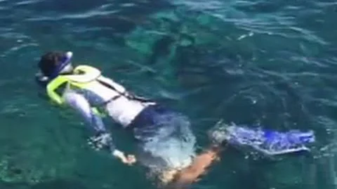 Shark Attack Survivor Gets Leg Rebuilt By Doctors