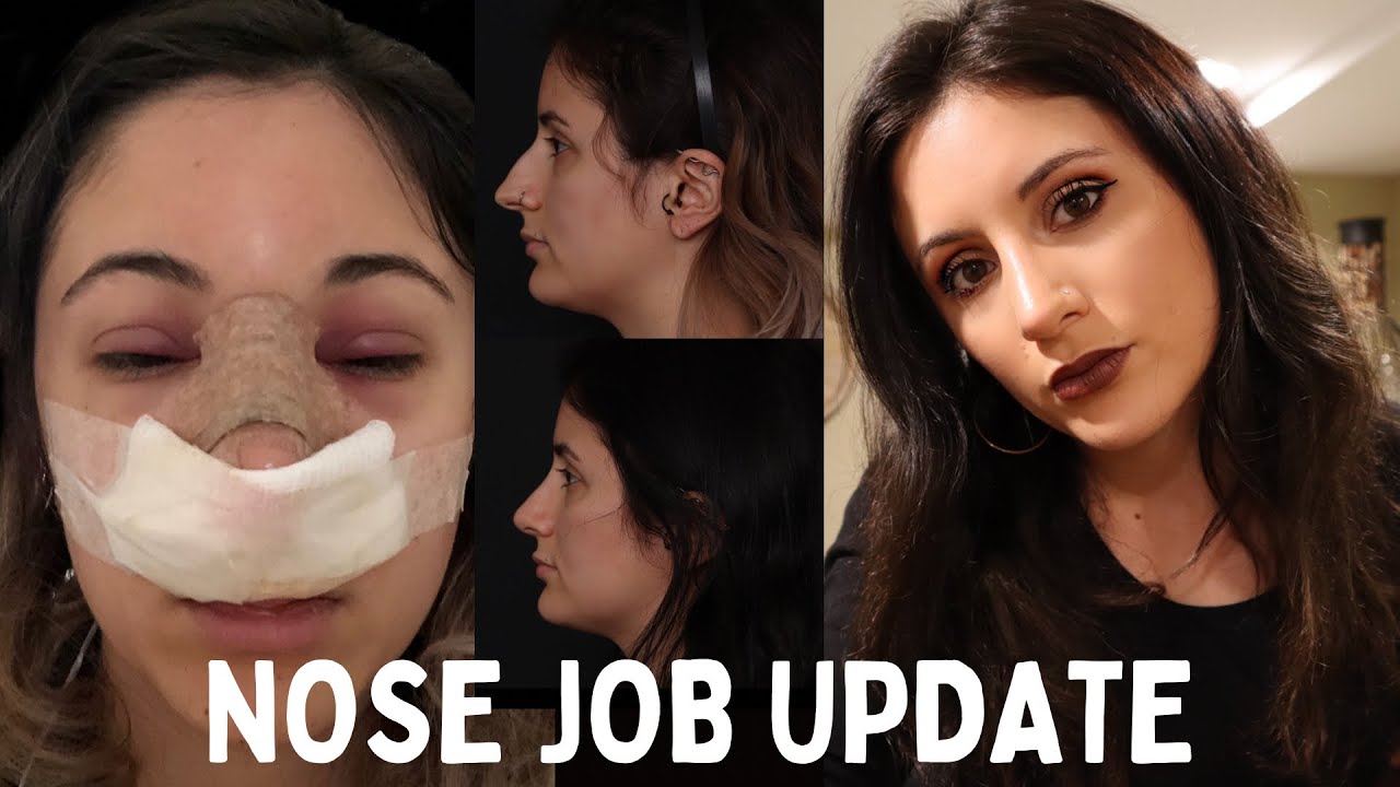 6 MONTH NOSE JOB UPDATE Was it Worth it? The Truth YouTube