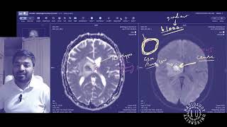Episode 3: appraoch to a neuroradiology case in FRCR 2b viva (MRI brain)