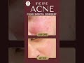 Acne Treatment Results | cosmo care and hair clinic