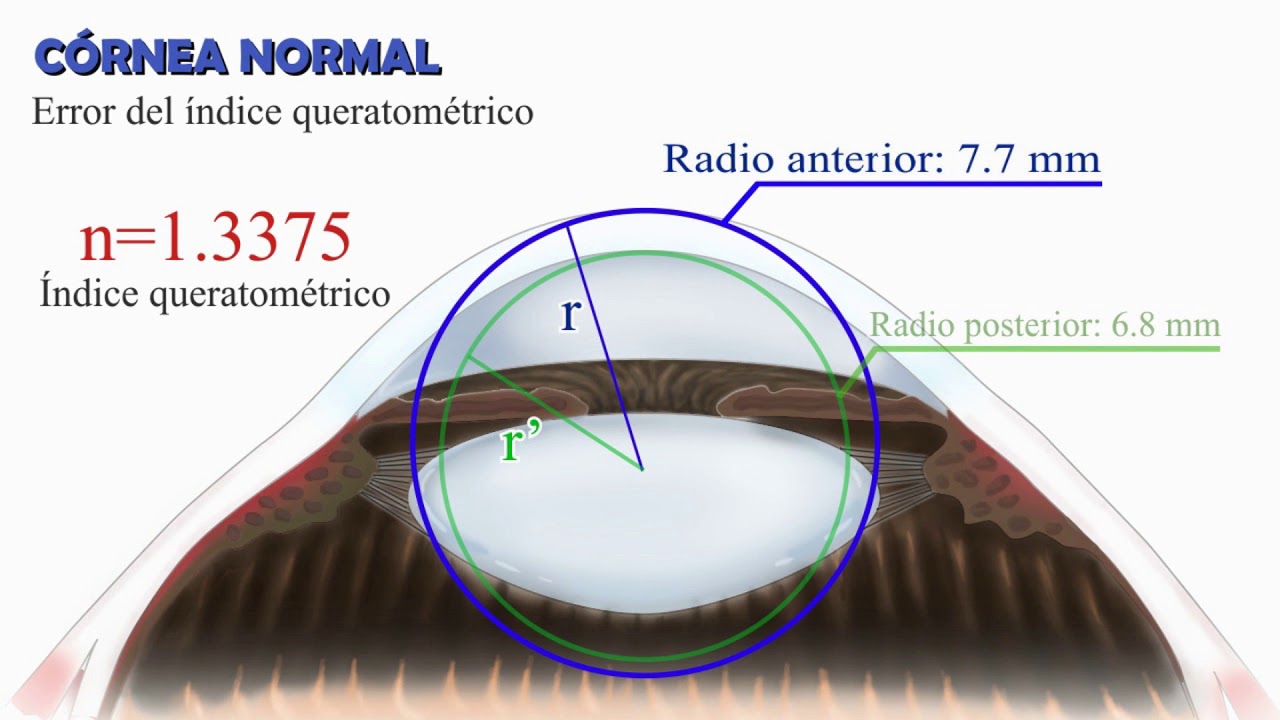 Calculo De Lente Intraocular Cálculo del poder del lente intraocular luego de cirugía refractiva
