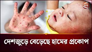 ময়মনসিংহে ২৪ ঘণ্টায় হামে আক্রান্ত হয়ে এক শিশুর মৃত্যু | Mymensingh News | Channel 24 screenshot 1