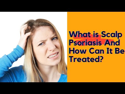 What Is Scalp Psoriasis And How Can It Be Treated? || Scalp Psoriasis Treatment